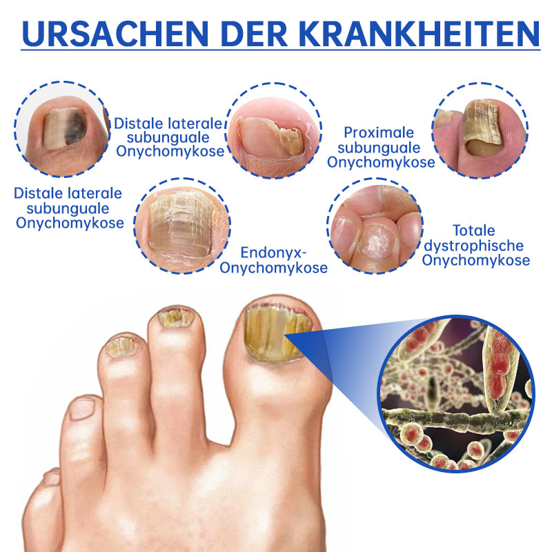 PureNail™ | Pilz-Lasertherapiegerät - Ihre Geheimwaffe gegen Nagelpilz