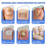 PureNail™ | Pilz-Lasertherapiegerät - Ihre Geheimwaffe gegen Nagelpilz